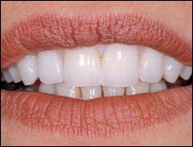 Les facettes dentaires