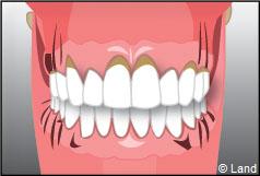 Les maladies des gencives