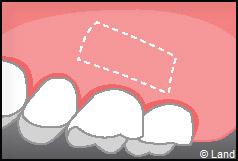Chirurgie mucogingivale